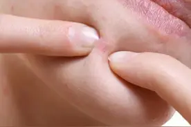 脸部不同区域长痘的原因你知道吗？图片