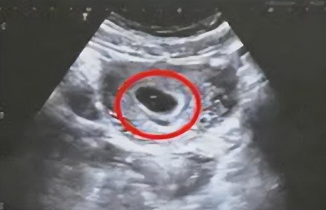 空孕囊是什么原因造成的呢?（hcg24万出现空孕囊揭秘空孕囊形成的7大原因）