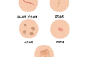 治疗疤痕的五大误区！图片