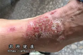 小腿身上脚上手上大腿根部起一片癣发痒结痂脱皮怎么办用什么药图片