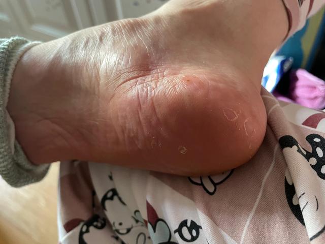 单侧鳞屑角化型足藓