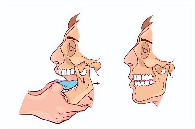 科普:下巴掉了,该如何应对