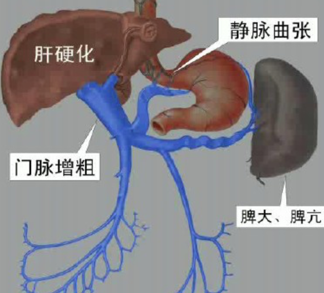 肝硬化患者为何往往伴随脾脏肿大，应如何治疗？