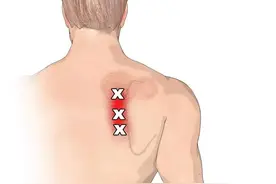 肩胛骨内侧缘疼痛是什么问题？肿瘤引发？告知您4种病因，请收藏图片