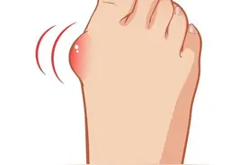 拇趾又歪又肿痛！这个女性高发病你得要小心图片