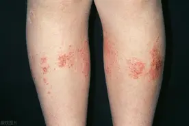 190斤女性夏天湿疹缠身，都是湿气惹的祸，四种方法祛湿能改善图片