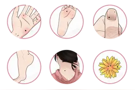 再次劝告：长在6个部位的痣，或与癌症“密不可分”，及时处理图片