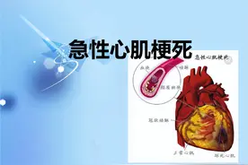 做什么检查，能早点预知心肌梗死？心血管医生这次说明白了图片
