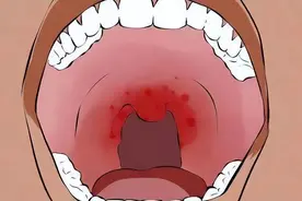 别再等它自愈了！口腔溃疡总不好，当心口腔癌图片