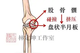 医林正骨丨这种“脆弱”的半月板，跳绳难省心，4000下跳进医院…图片