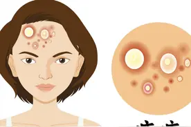 这种痤疮一般人躲不掉？医生提醒：5点病因要了解，对症下药！图片