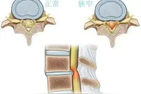 引起椎管狭窄的原因及治疗方法图片