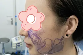 整形10年反复打美容针把自己打成了馒化脸，80后女士来做取出修复图片