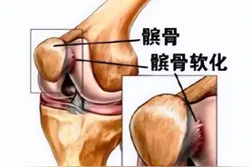 引起膝关节疼痛原因很多，髌骨软化症不可忽视图片