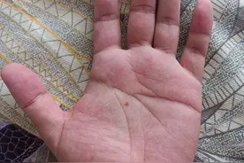 小小光纤扎手，不就去手指扎刺吗？为什么医院都说治不好？图片
