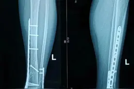 钢板（内固定器）取还是不取？看完这篇文章后心里就有答案了图片