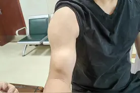 男子右臂鼓起大包似“大力水手”，经核磁共振查明病因图片
