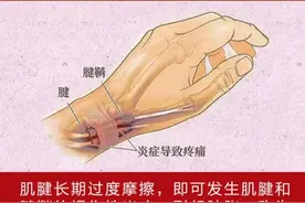 腱鞘炎是什么图片