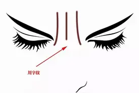 什么是川字纹，该如何消除川字纹？图片