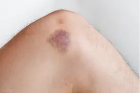 磕磕碰碰不是小事！淤青应该怎么治？首先要明确这2点图片