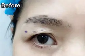 眼皮耷拉、松弛、三角眼，医生说这两种方法还不错图片