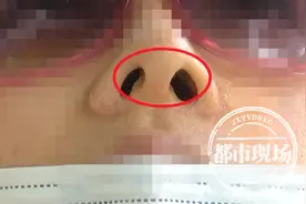 南昌：女子做完隆鼻手术后，鼻孔一大一小，她说“越做越难看”图片