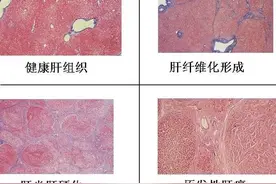肝病医生说乙肝暂不治疗，建议继续随访时，需要知道哪些方面？图片