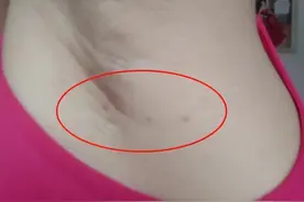 脖子和腋下的“小肉粒”是什么？可以直接用手揪掉吗？不妨了解图片