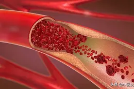 4个中成药，活血，通络，抗血栓，预防心脑血管病，中风，脑梗图片