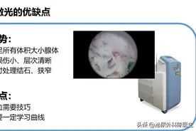 前列腺微创治疗的新金标准——激光技术图片