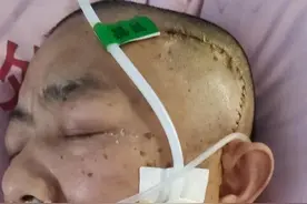 你们身边有脑出血的病人，现在都怎么样了？图片
