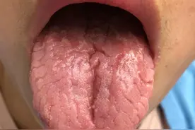 心烦、手脚心热六味地黄没用？舌象告诉你原因，教你正确用中成药图片