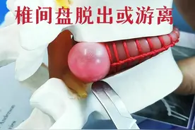突出的腰椎间盘能不能自我吸收？医生说：有可能，但几率仅为3%图片