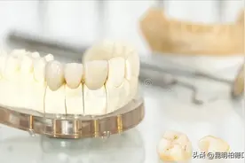 做完根管治疗之后选择牙冠还是嵌体？看完帮你省下一顿大餐钱图片