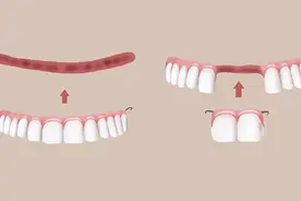 老年人戴一口活动假牙，5个细节要注意，想要牙口好，护理少不了图片