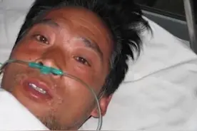 日本工人遭核辐射，被当白鼠强行续命83天，临终前烂成“烤全羊”图片