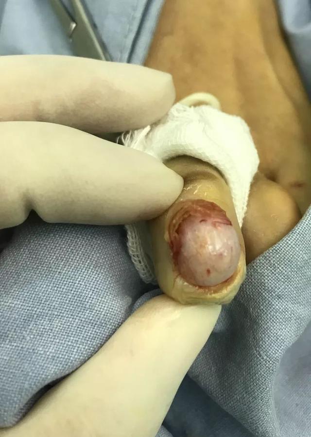 宝宝口腔白色角化株