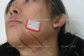 郑州市第二中医院：手术疤痕怎么修复好？图片