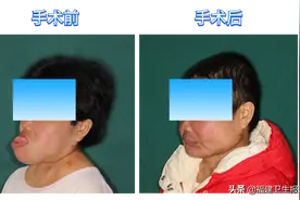 福州女子长着一张“猿脸”，30年无法见人！医生为她重建五官，实现从“猿”到人图片
