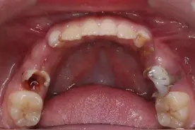 后悔拔掉烂牙根？医生提醒：这样的烂牙一样可以保留不拔图片