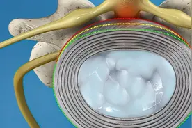 腰椎间盘突出症患者的福音，微创椎间孔镜手术过程详解图片