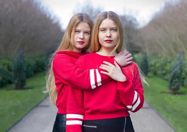 连体人是如何形成的?如果其中一个死亡,另外一个还能活下来吗?