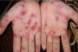 除了艾滋病，你还知道哪个严重的性病？图片