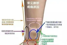 跑步时膝盖疼，戴护膝有用吗？图片