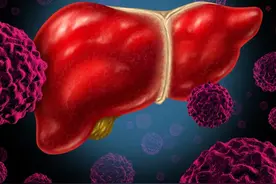 一文读懂丨肝癌的CT影像诊断要点图片