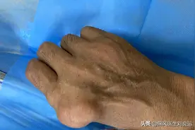 痛风就会长痛风石吗？什么样的痛风石需要手术取石？医生告诉您图片