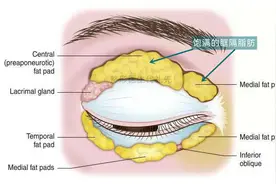 眼睑凹陷、眼窝凹陷，形成原因与如何进行年轻化改善？图片