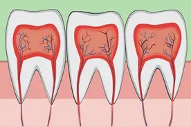 「杀死」牙神经后，牙齿还能“活”多久？图片