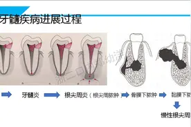 牙龈肿胀、疼痛、脓包，可能根尖周发炎了图片