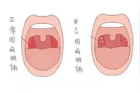 扁桃体发炎太痛苦？看这里，了解有关扁桃体炎的那些事图片